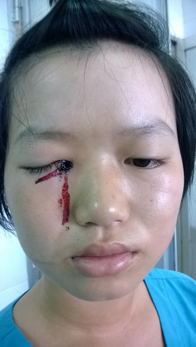 Trẻ đâm bút vào mắt bạn trong lúc đùa giỡn